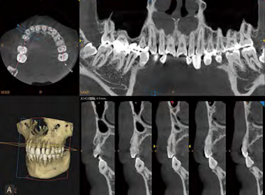 歯科用CTで撮影した３D画像