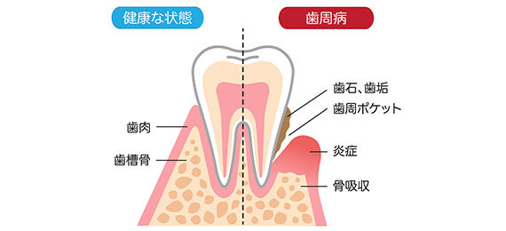 歯を失う原因1位の歯周病