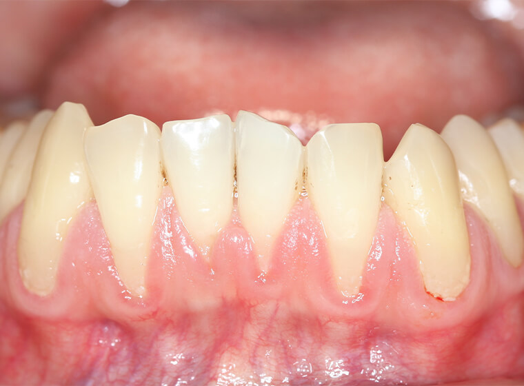 重度の歯周病には再生療法を行います