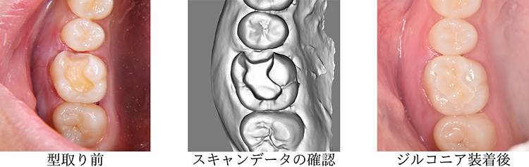 型取り＆セット