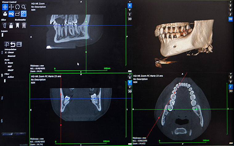 顎関節CT検査