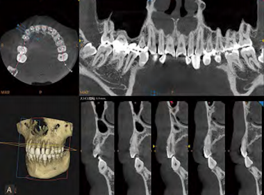 歯科用CT