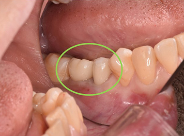 自分の歯のようなインプラント治療をした奥歯の画像