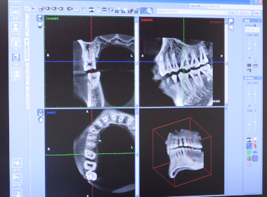 歯科用CTで骨の状態を分析