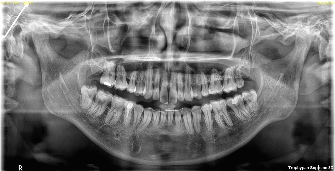 【症例】変色した前歯のレジンの詰め替えとレジン下の虫歯治療