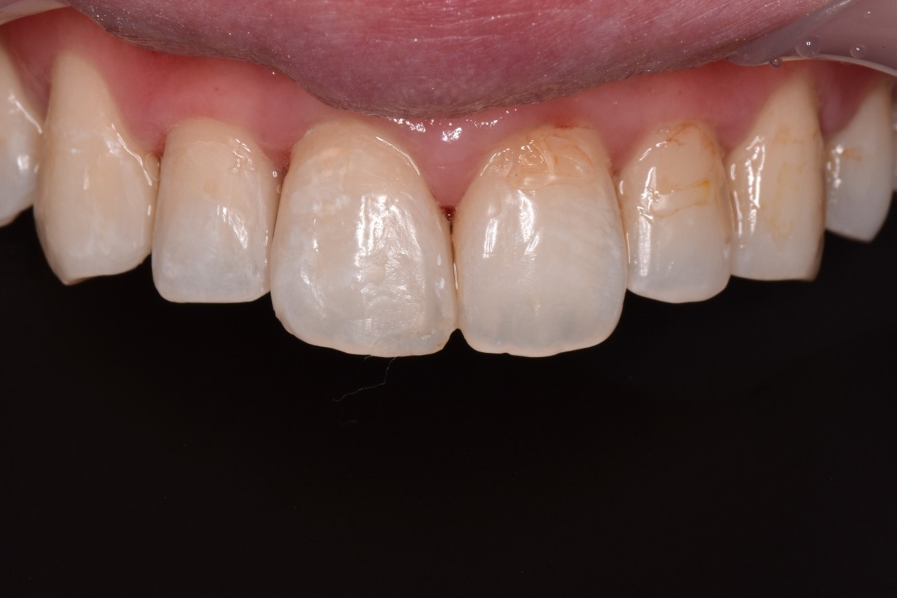 【症例】変色した前歯のレジンの詰め替えとレジン下の虫歯治療