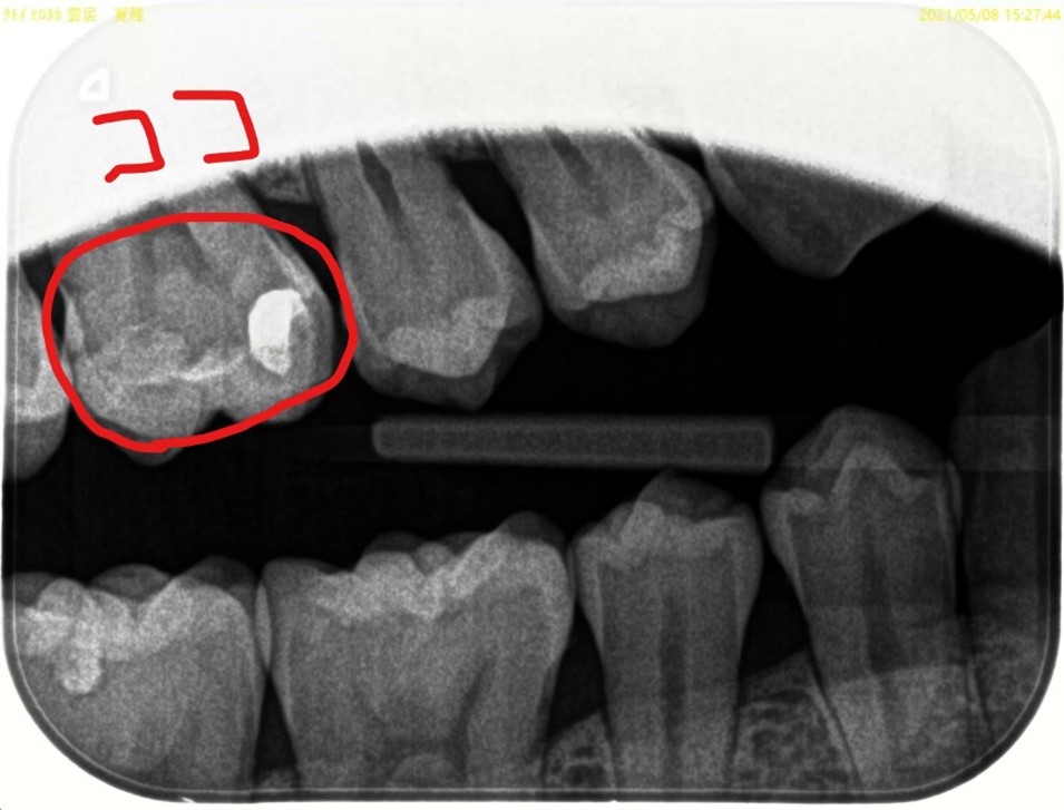 【症例】検診で見つかった白い詰め物の下の虫歯の治療