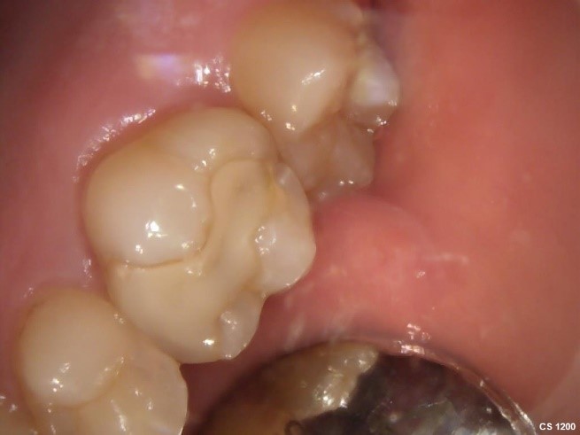 【症例】検診で見つかった白い詰め物の下の虫歯の治療