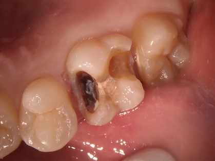 【症例】検診で見つかった白い詰め物の下の虫歯の治療