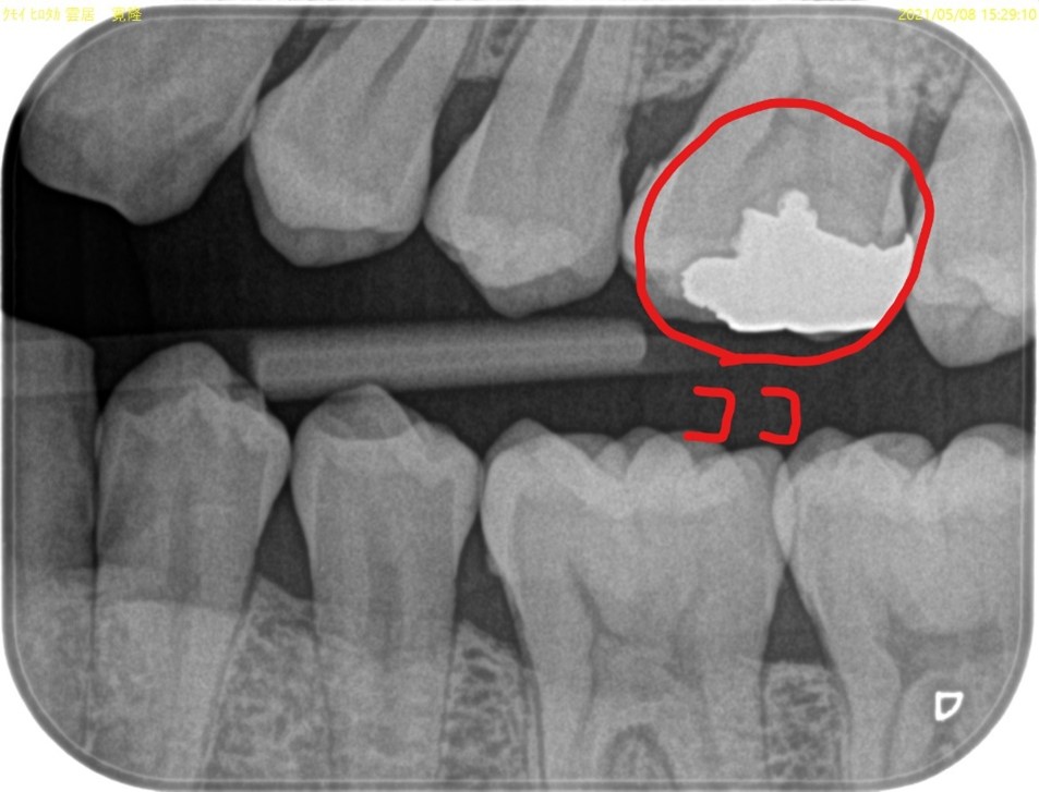 【症例】検診で見つかった金属の詰め物の下の虫歯の治療