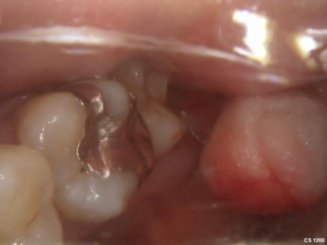 【症例】検診で見つかった金属の詰め物の下の虫歯の治療