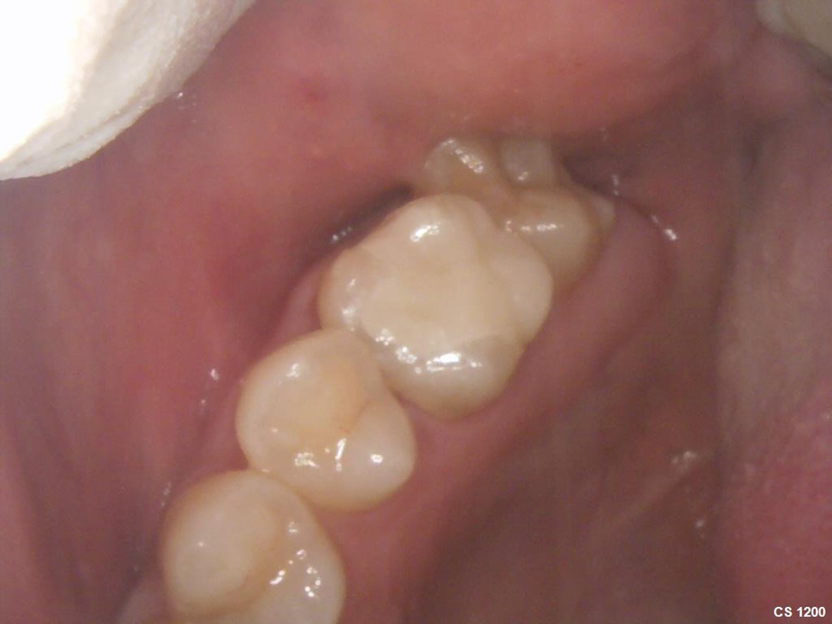 【症例】検診で見つかった金属の詰め物の下の虫歯の治療