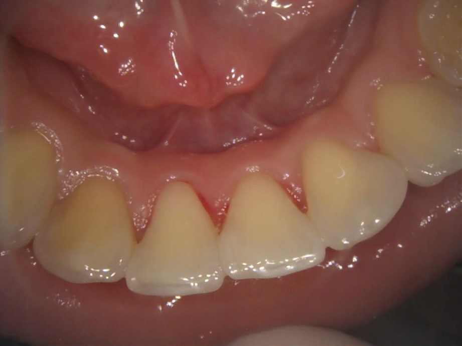 【症例】歯のクリーニング＿頑固な歯石は歯ブラシでは取れません！