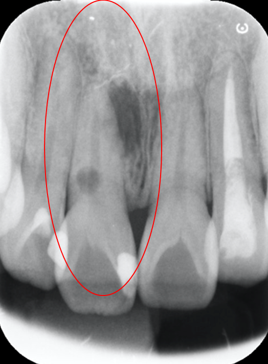 【症例】MTAセメントによる側枝および歯根吸収を有する歯の根尖性歯周炎の治療