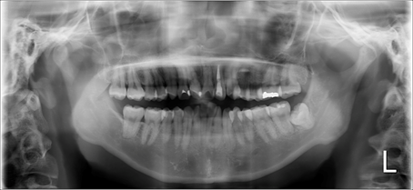 【症例】MTAセメントによる側枝および歯根吸収を有する歯の根尖性歯周炎の治療