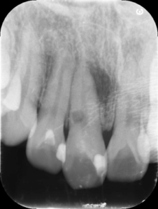 【症例】MTAセメントによる側枝および歯根吸収を有する歯の根尖性歯周炎の治療｜治療前の画像1｜渋谷の歯医者 渋谷マロン歯科