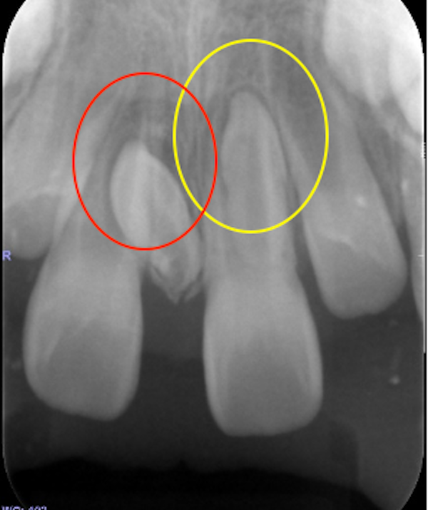 【症例】過剰歯（余分な歯）の抜歯で、正中離開（上の前歯のすきっぱ）を改善