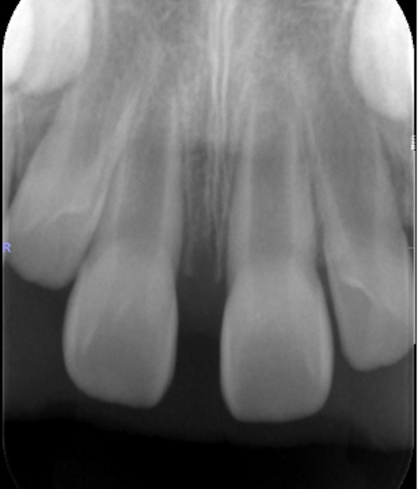 【症例】過剰歯（余分な歯）の抜歯で、正中離開（上の前歯のすきっぱ）を改善