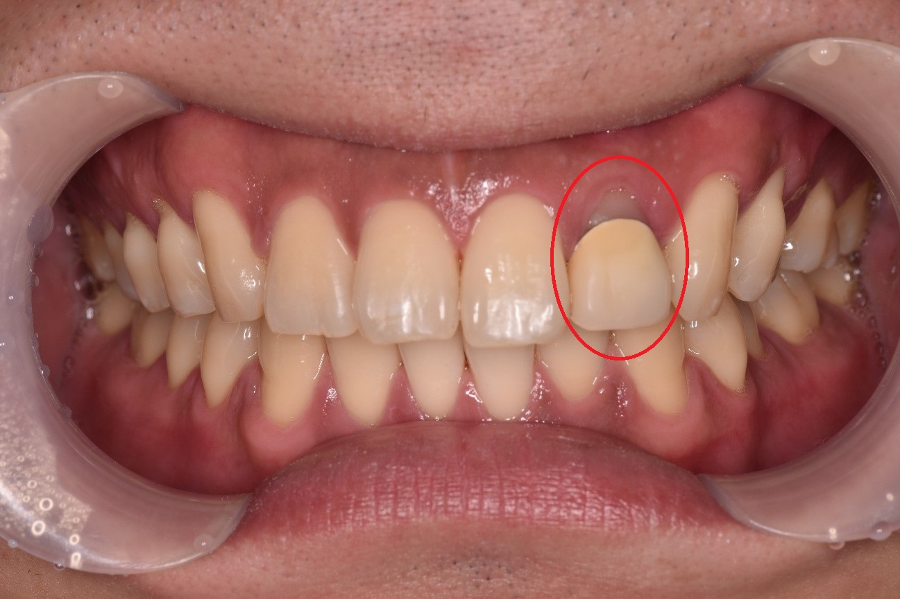 【症例】上顎左側側切歯の根管治療と被せ物