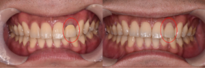 【症例】上顎左側側切歯の根管治療と被せ物|治療のビフォーアフター｜渋谷の歯医者 渋谷マロン歯科Tokyo