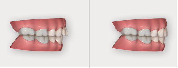 shibuya Marron Dental Clinic Tokyo｜case｜InvisalignGo｜before-after_05