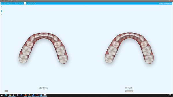 shibuya Marron Dental Clinic Tokyo｜case｜InvisalignGo｜lower_08