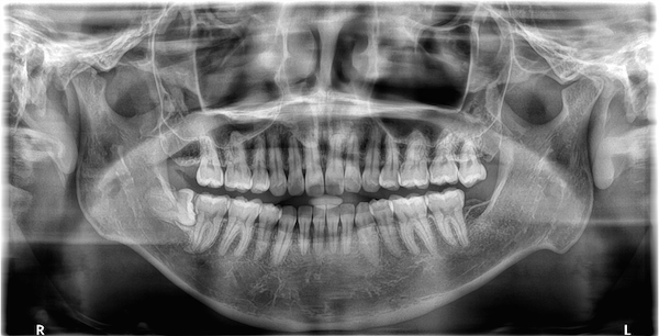 shibuya Marron Dental Clinic Tokyo｜case｜InvisalignGo｜roentgen_15