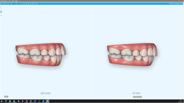 shibuya Marron Dental Clinic Tokyo｜case｜InvisalignGo｜side_09