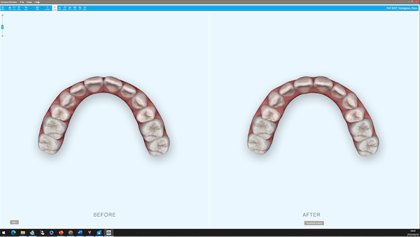 shibuya Marron Dental Clinic Tokyo｜case｜InvisalignGo｜upper-side_07-2