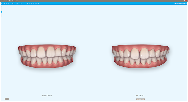 shibuya Marron Dental Clinic Tokyo｜case｜InvisalignGo｜upper-side_07