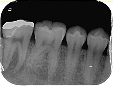 渋谷マロン歯科Tokyo｜症例｜【症例】右奥歯に対して専門根管治療と補綴治療を施行した症例｜治療前のレントゲン画像