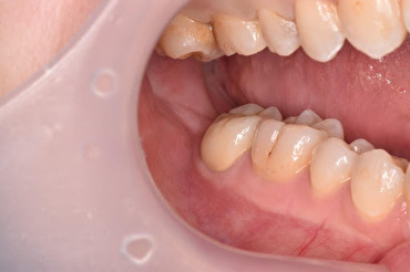 【症例】右奥歯の専門的な根管治療とジルコニアクラウンでの被せもの治療