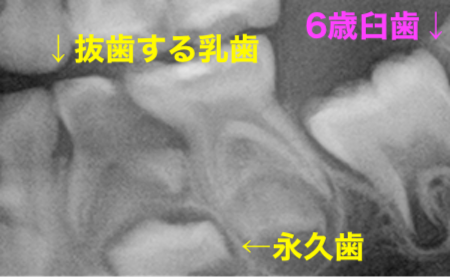 渋谷マロン歯科Tokyo｜症例｜乳歯の抜歯後、永久歯がまっすぐ生えるようバンドループを装着｜治療前のレントゲン画像3