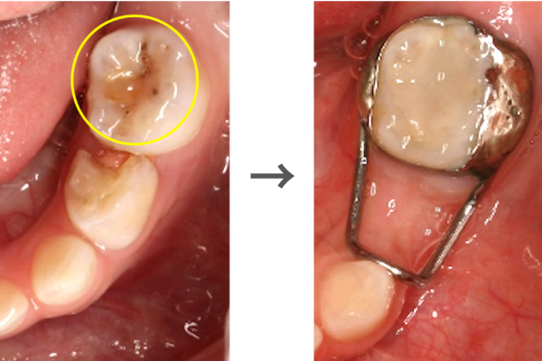 【症例】乳歯の抜歯後、永久歯がまっすぐ生えるようバンドループを装着