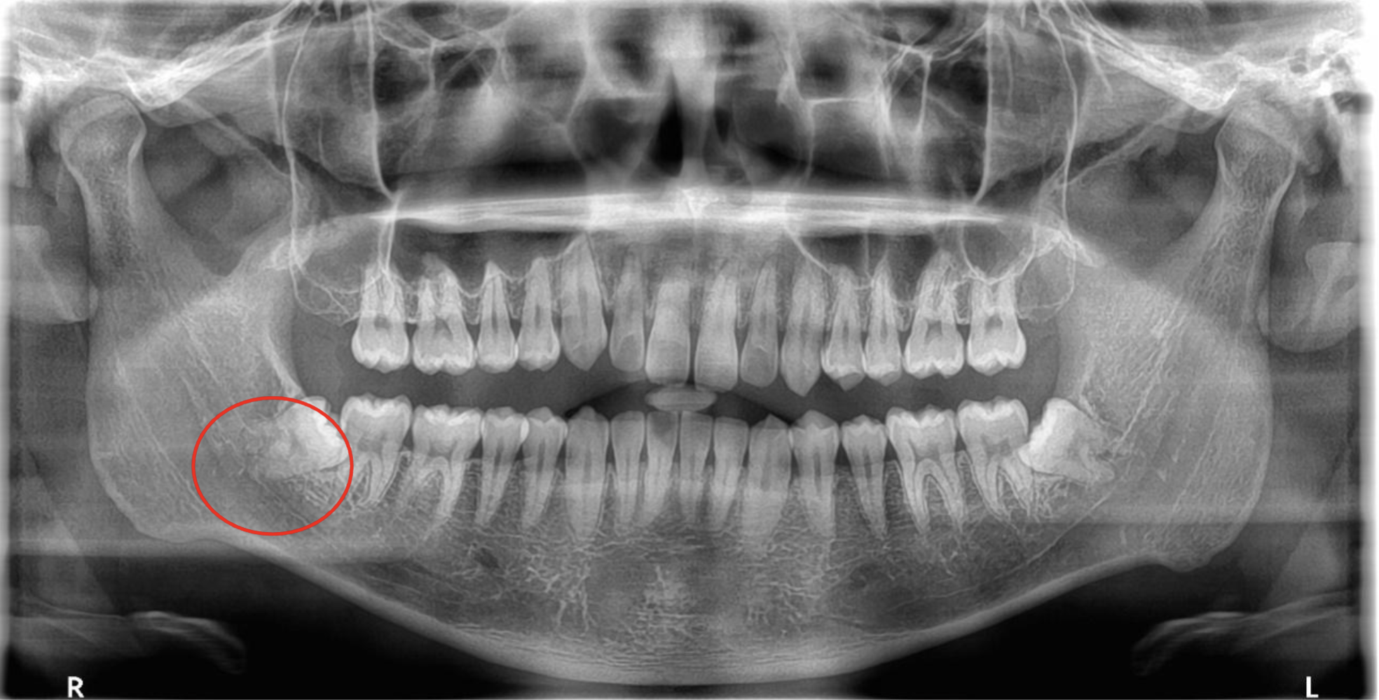 渋谷マロン歯科Tokyo｜症例｜【症例】骨に埋まっている親知らずを抜歯｜レントゲン画像