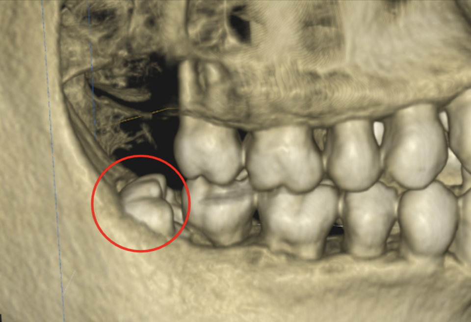 渋谷マロン歯科Tokyo｜症例｜【症例】骨に埋まっている親知らずを抜歯｜CTの画像