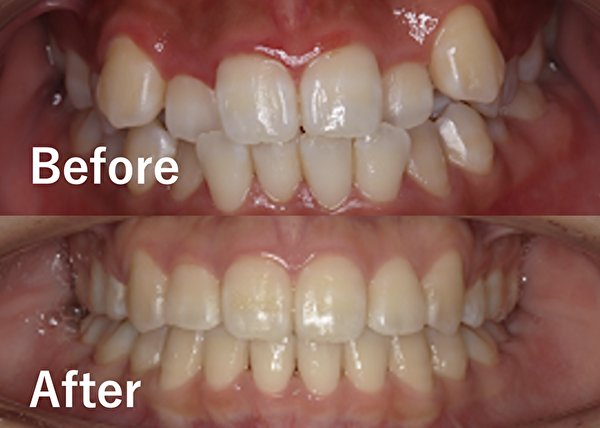 【症例】ガタガタの前歯をワイヤー矯正で歯並びを改善