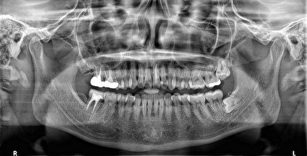 渋谷マロン歯科Tokyo｜症例｜【【症例】痛みがある左上の前歯を審美補綴した症例｜レントゲンの画像
