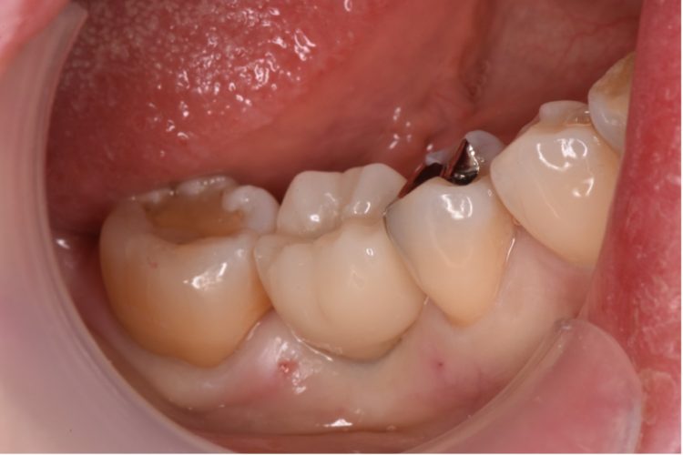 【症例】歯を抜いてから長期間放置後のインプラント治療