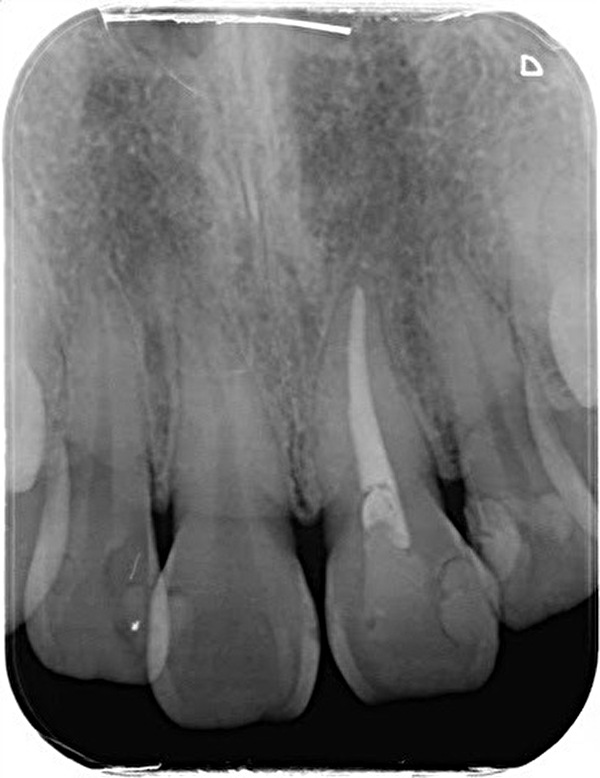 渋谷マロン歯科Tokyo｜症例｜【【症例】痛みがある左上の前歯を審美補綴した症例｜前歯のレントゲンの画像