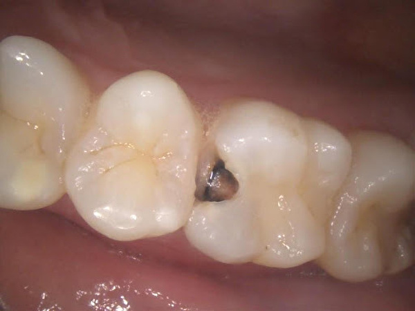 【症例】神経近くまで到達した虫歯に対する歯髄（歯の神経）の保存