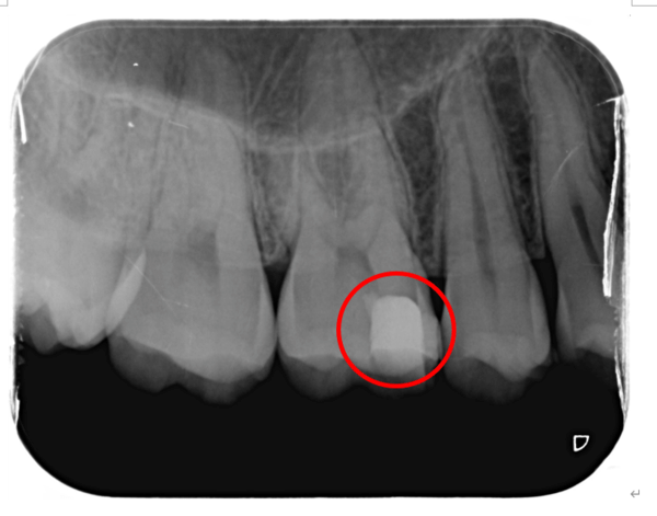渋谷マロン歯科Tokyo｜症例｜【症例】神経近くまで到達した虫歯に対する歯髄（歯の神経）の保存｜レントゲン画像3