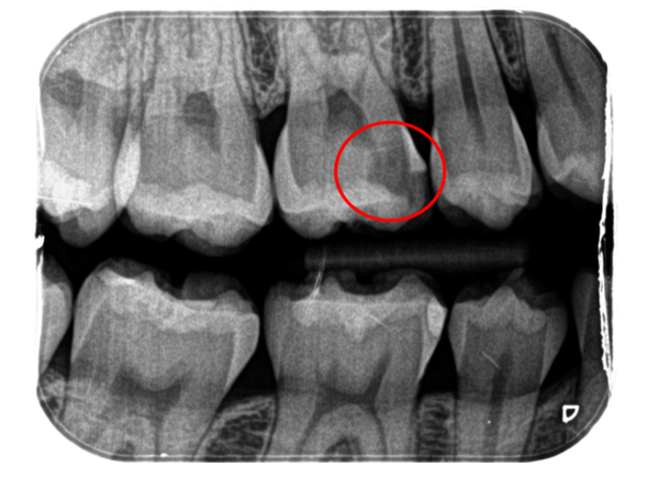 渋谷マロン歯科Tokyo｜症例｜【症例】神経近くまで到達した虫歯に対する歯髄（歯の神経）の保存｜レントゲン画像2