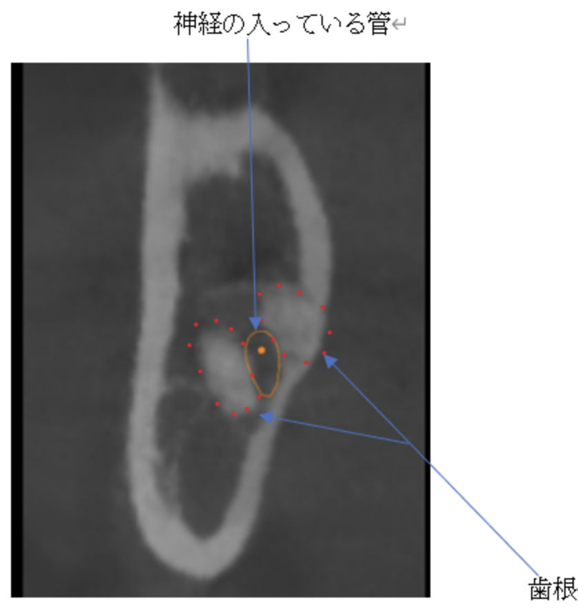 渋谷マロン歯科Tokyo｜症例｜【症例】骨に埋まっている親知らずを抜歯｜歯根と神経管の画像