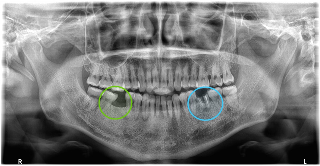 【症例】インプラントで左右の歯の欠損を別々の方法で治療（静脈内鎮静法下）
