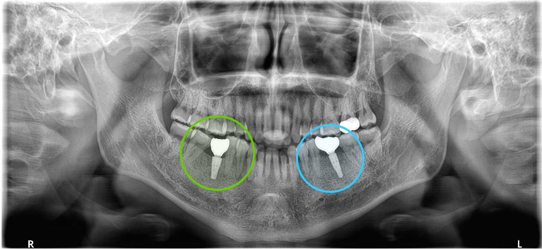 インプラント治療後のレントゲン画像｜【症例】インプラントで左右の歯の欠損を別々の方法で治療｜渋谷の歯医者-渋谷マロン歯科