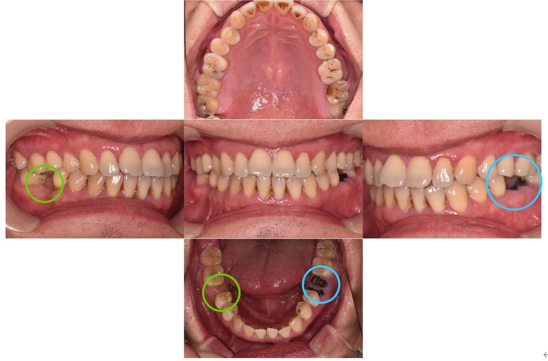 治療前の口腔内写真｜【症例】インプラントで左右の歯の欠損を別々の方法で治療｜渋谷の歯医者-渋谷マロン歯科