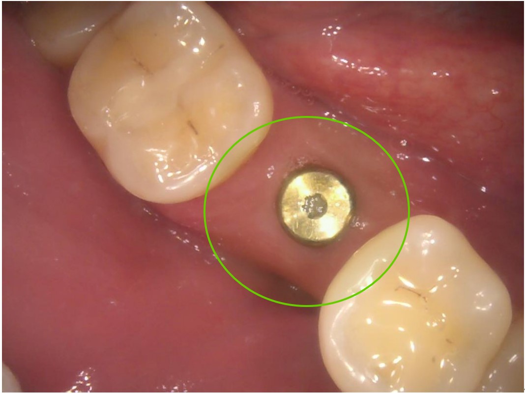 ガイデッドサージェリーで埋め込んだインプラントの画像｜【症例】インプラントで左右の歯の欠損を別々の方法で治療｜渋谷の歯医者-渋谷マロン歯科