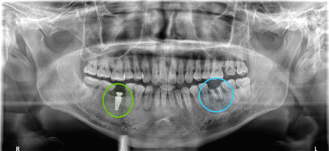ガイデッドサージェリーで埋め込んだインプラントのレントゲン画像｜【症例】インプラントで左右の歯の欠損を別々の方法で治療｜渋谷の歯医者-渋谷マロン歯科