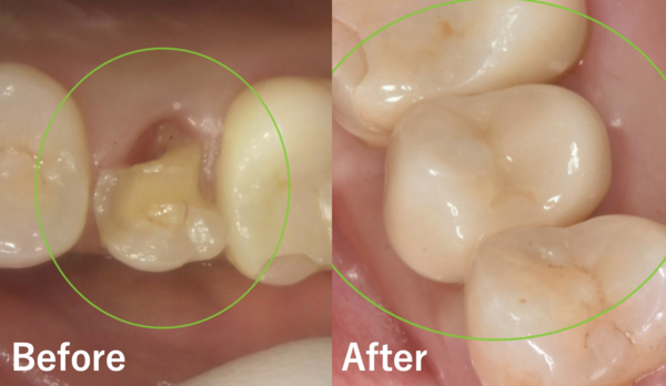 【症例】難症例を抜歯即時インプラント治療で審美的に改善